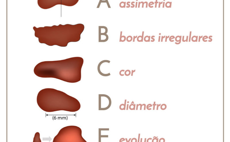 ABCDE DO MELANOMA